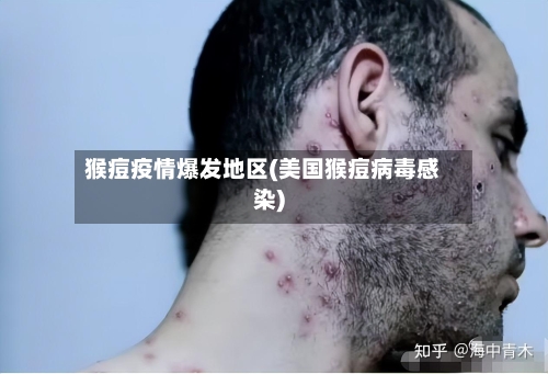 猴痘疫情爆发地区(美国猴痘病毒感染)